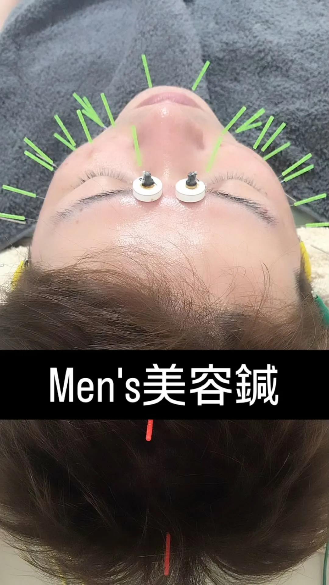 メンズ美容鍼💆‍♂️